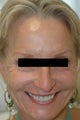 Dysport Injections Before and After Photos
