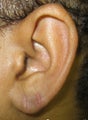 Torn Earlobe Repair