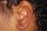 Split earlobe repair