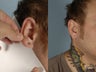 Gauged Earlobe Repair