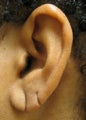 Torn Earlobe Repair
