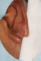 Split earlobe repair