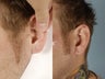 Gauged Earlobe Repair
