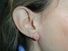 Ear Surgery