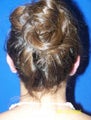 Otoplasty (Ear Surgery)