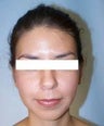Otoplasty (Ear Surgery)