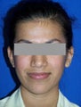 Ear Surgery (otoplasty)