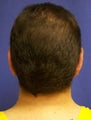 Ear Surgery (otoplasty)