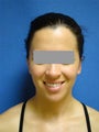 Ear Surgery (otoplasty)