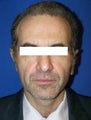 Ear Surgery (otoplasty)