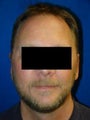Ear Surgery (otoplasty)