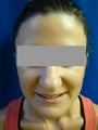 Ear Surgery (Otoplasty)