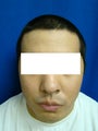 Ear Surgery (otoplasty)