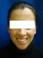 Ear Surgery (otoplasty)