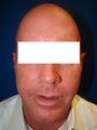 Ear Surgery (otoplasty)