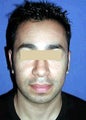Otoplasty (Ear Surgery)