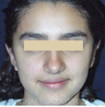 Otoplasty (ear set-back)