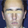Bilateral Otoplasty (EAR-SET BACK)