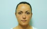 Otoplasty