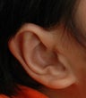 Otoplasty (Ear set-back and refinement)