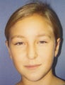 Otoplasty