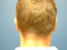 Otoplasty (correction of outstanding ears)