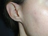 Ear Surgery