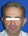 Ear Surgery (otoplasty)