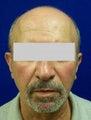 Ear Surgery (otoplasty)