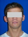 Ear Surgery (otoplasty)