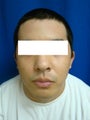 Ear Surgery (otoplasty)