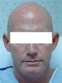 Ear Surgery (otoplasty)