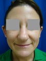Ear Surgery (Otoplasty)