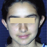 Otoplasty (ear set-back)