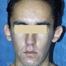 Bilateral Otoplasty (EAR-SET BACK)