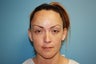 Otoplasty