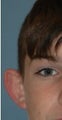 Otoplasty