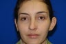 Otoplasty