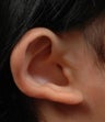 Otoplasty (Ear set-back and refinement)
