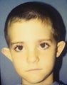 Otoplasty