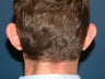 Otoplasty (correction of outstanding ears)