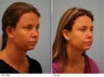 Otoplasty