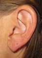Split Ear Lobe Surgery
