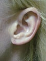 Torn Ear Lobe Repair