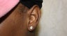 Earlobe Keloid 