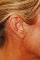 Earlobe Repair