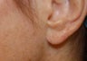 Earlobe Repair