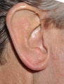 Earlobe Reduction