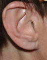 Earlobe Reduction