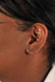 Earlobe Repair